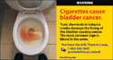 Blood in the toilet due to bladder cancer.