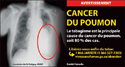 Radiographie thoracique démontrant un poumon atteint du cancer.