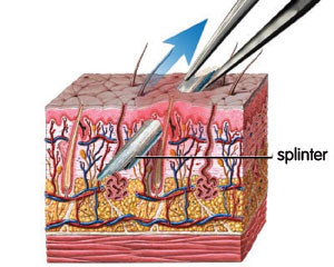splinter in the skin - description follows