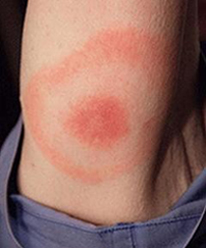 A skin rash called erythema migrans can develop into a bull's eye at the site of a tick bite. It is shown here on the upper arm.