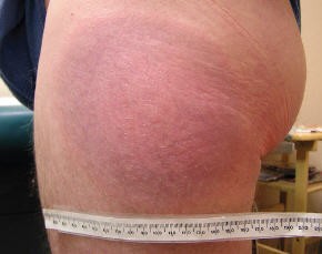 A large circular skin lesion on a patient’s upper leg. The lesion has a blue-purple colour. A tape measure shows that it is over 16 cm wide.