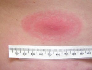 An oval-shaped erythema migrans rash that can take on the appearance of a bull's eye. A tape measure is placed beneath it and shows that the rash is over 7 cm wide.