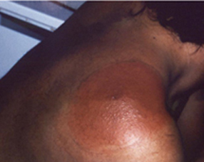 A raised, circular, reddish-brown rash on a patient’s shoulder.
