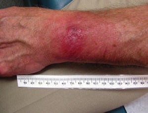 A red rash and blisters on a forearm, with a tape measure showing that the rash is 13 cm wide and the blister over 2 cm wide.