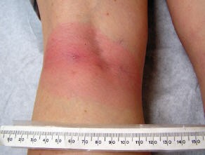 A red rash that has expanded across the width of the back of a knee. A tape measure is placed beneath it and shows that the rash is 8 cm wide.