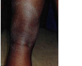 A dark brown rash on the back of a patient’s leg.