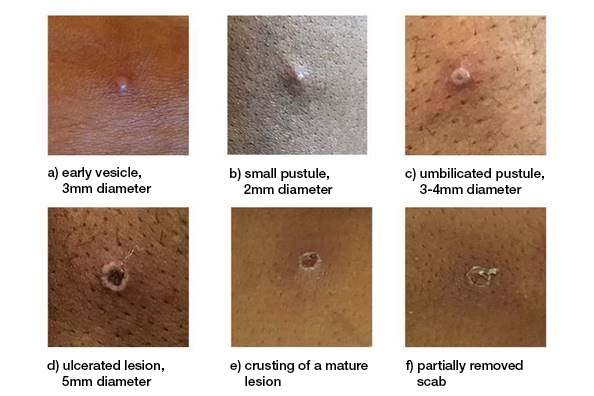 Figure 2. Series of six photographs that show the different stages of a monkeypox skin lesion