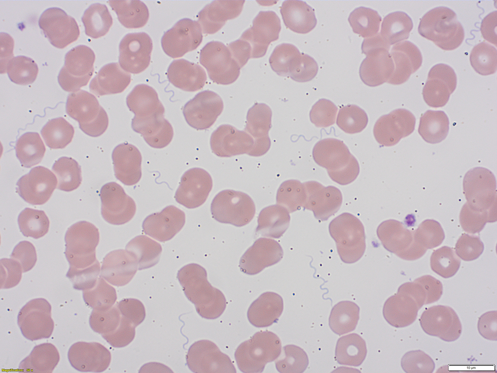 Figure 1 : Frottis sanguin périphérique coloré par Wright-Giemsa montrant des spirochètes