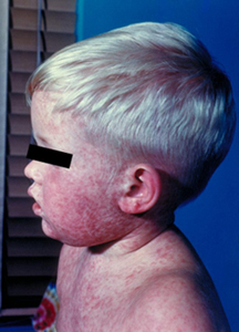 Public Health Notice: Measles — March 2014 - Canada.ca